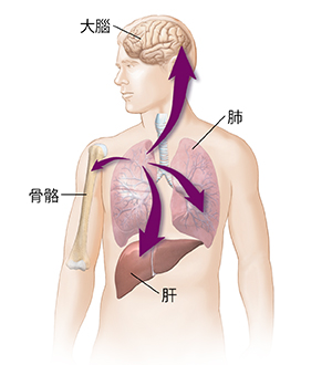 男性身體輪廓圖，箭頭顯示肺癌擴散到肝臟、另一個肺、骨骼和大腦。